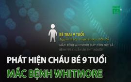 dak-lak-phat-hien-chau-be-9-tuoi-mac-benh-whitmore